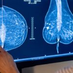El cribado con ayuda de la IA mejora la detección temprana del cáncer de mama | Salud y bienestar