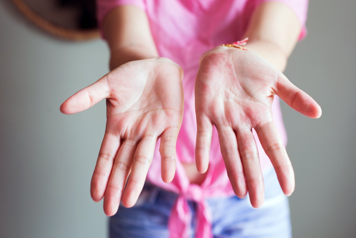 Mano con palmas enrojecidas y dedos en forma de palillo de tambor, señales de hígado enfermo